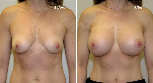 Silicone Breast Implants Before and After Photo by Ganchi Plastic Surgery in Northern New Jersey