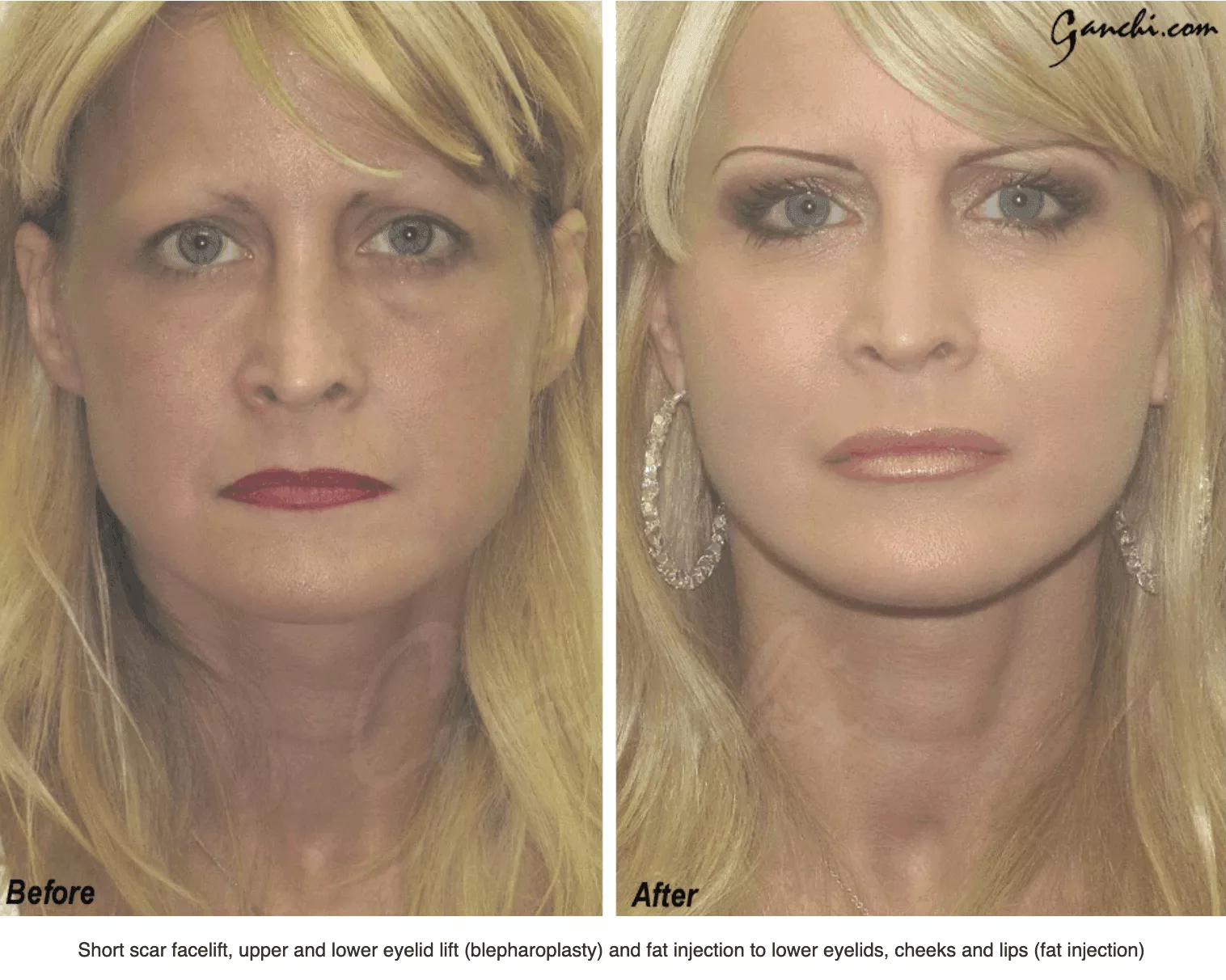 Before and After Photo by Ganchi Plastic Surgery in Northern New Jersey