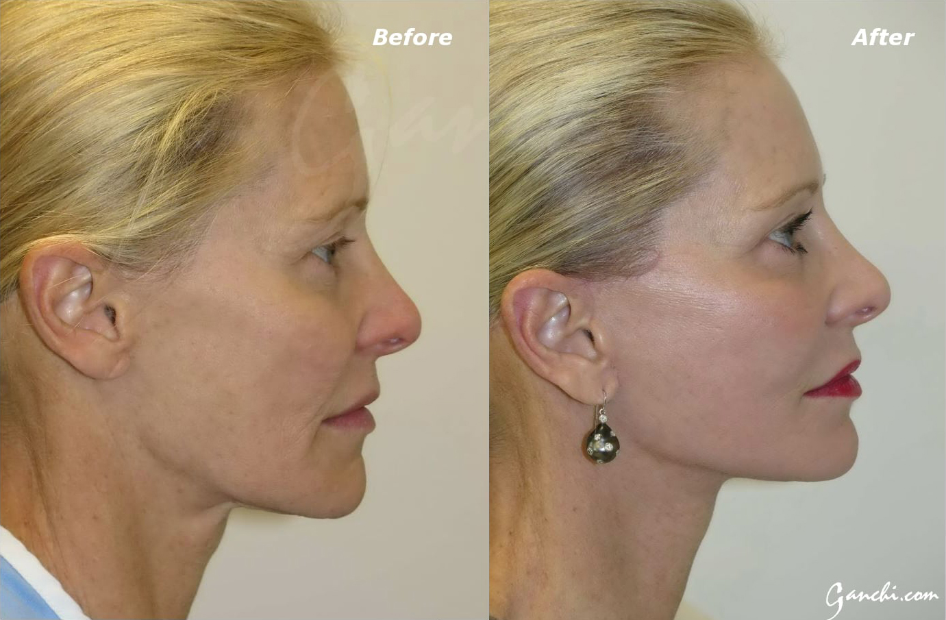 Facelift Before and After Photo by Ganchi Plastic Surgery in Northern New Jersey