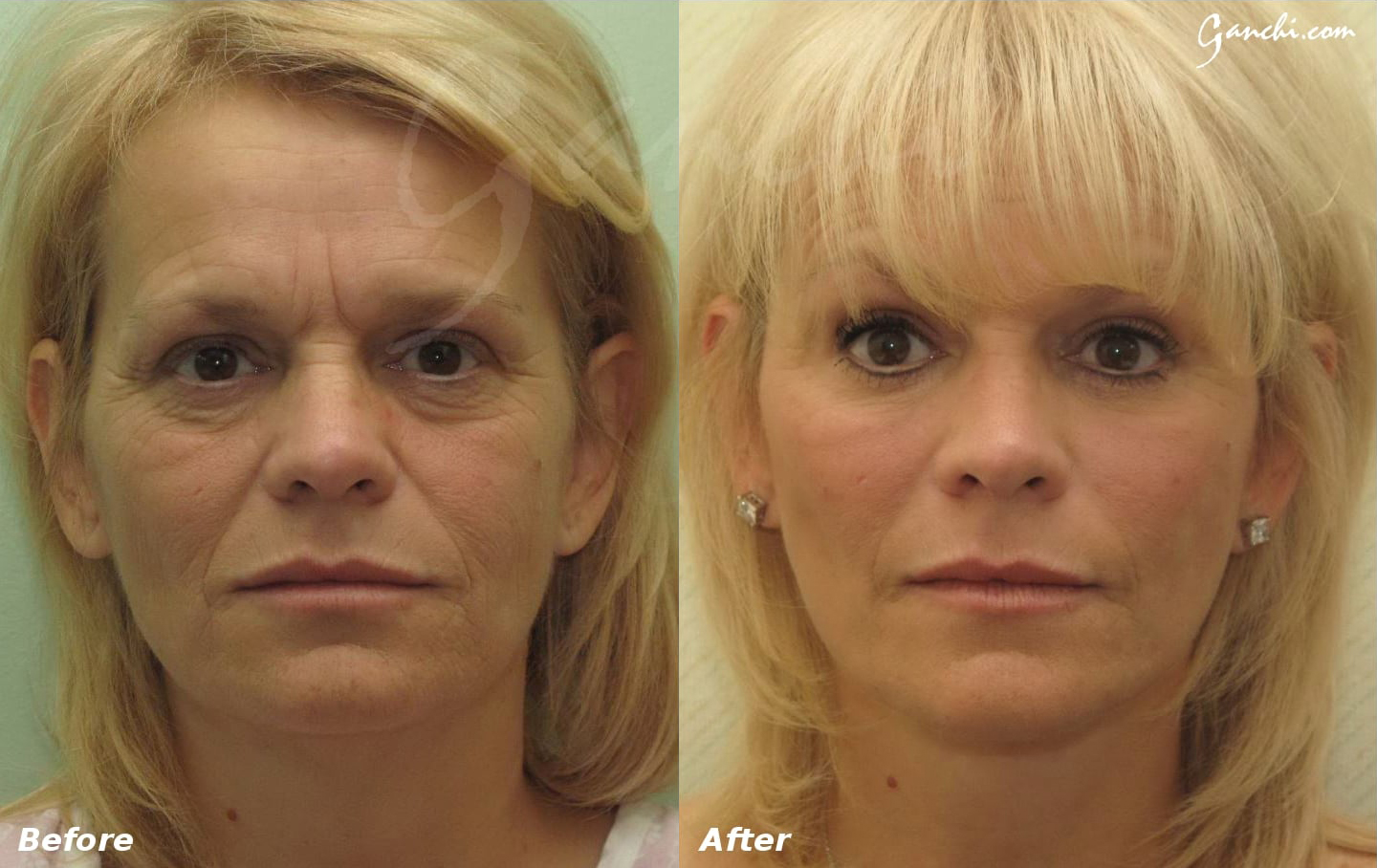 Facelift Before and After Photo by Ganchi Plastic Surgery in Northern New Jersey