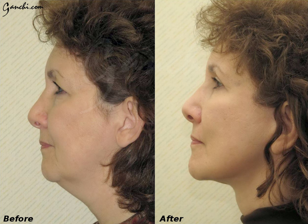 Facelift Before and After Photo by Ganchi Plastic Surgery in Northern New Jersey