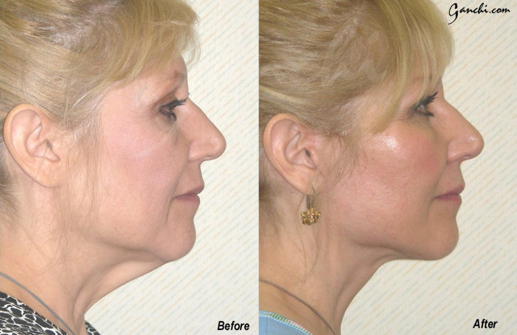 Facelift Before and After Photo by Ganchi Plastic Surgery in Northern New Jersey
