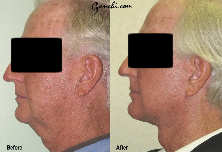 Facelift Before and After Photo by Ganchi Plastic Surgery in Northern New Jersey