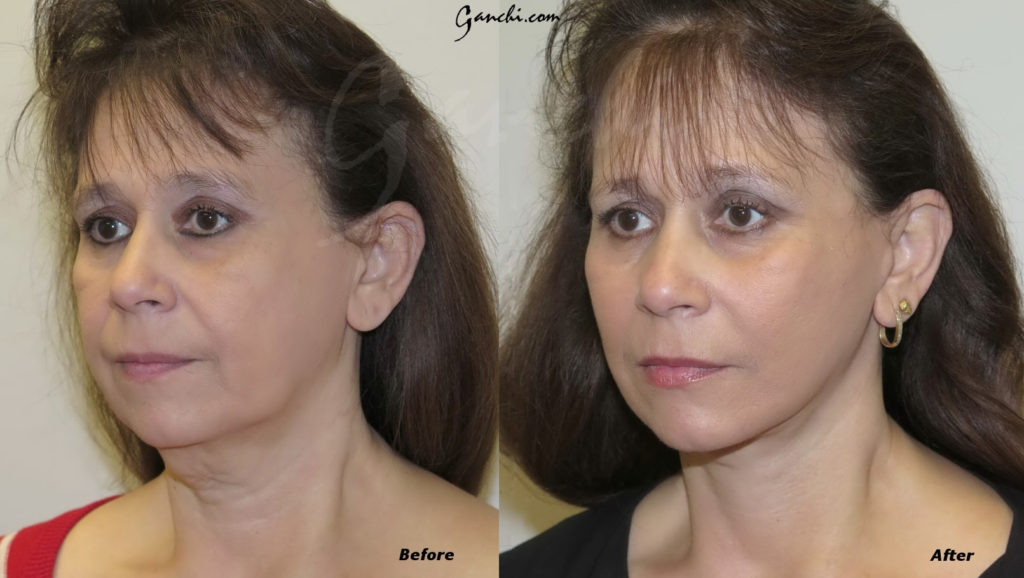 Facelift Before and After Photo by Ganchi Plastic Surgery in Northern New Jersey