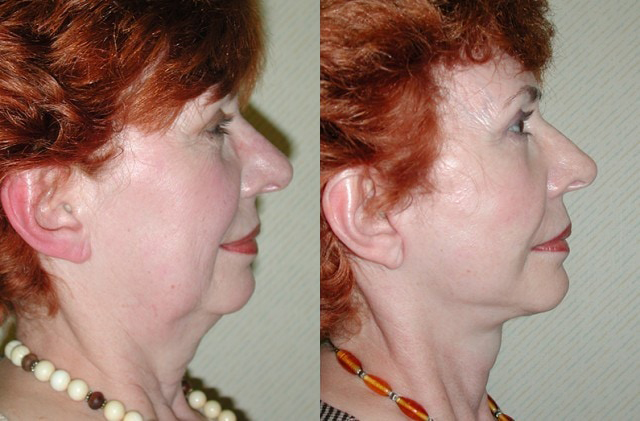 Facelift Before and After Photo by Ganchi Plastic Surgery in Northern New Jersey