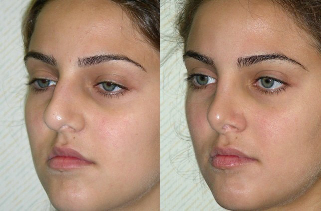 Rhinoplasty Before and After Photo by Ganchi Plastic Surgery in Northern New Jersey