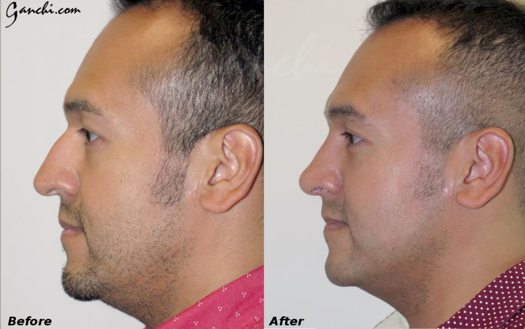 Rhinoplasty Before and After Photo by Ganchi Plastic Surgery in Northern New Jersey