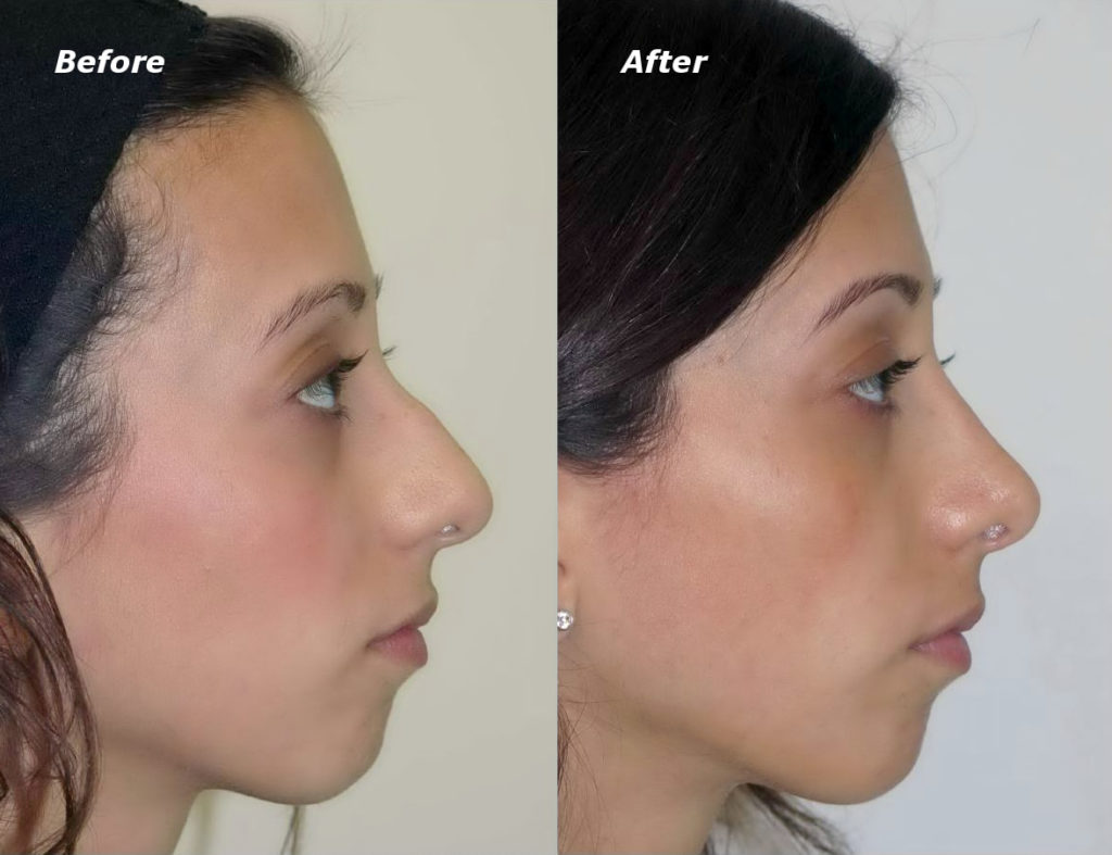 Rhinoplasty Before and After Photo by Ganchi Plastic Surgery in Northern New Jersey