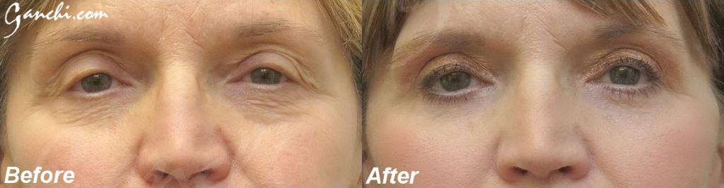 Eyelid Lift Before and After Photo by Ganchi Plastic Surgery in Northern New Jersey