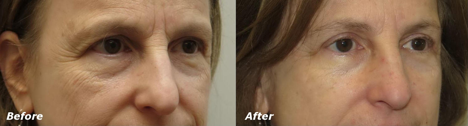 Eyelid Lift Before and After Photo by Ganchi Plastic Surgery in Northern New Jersey