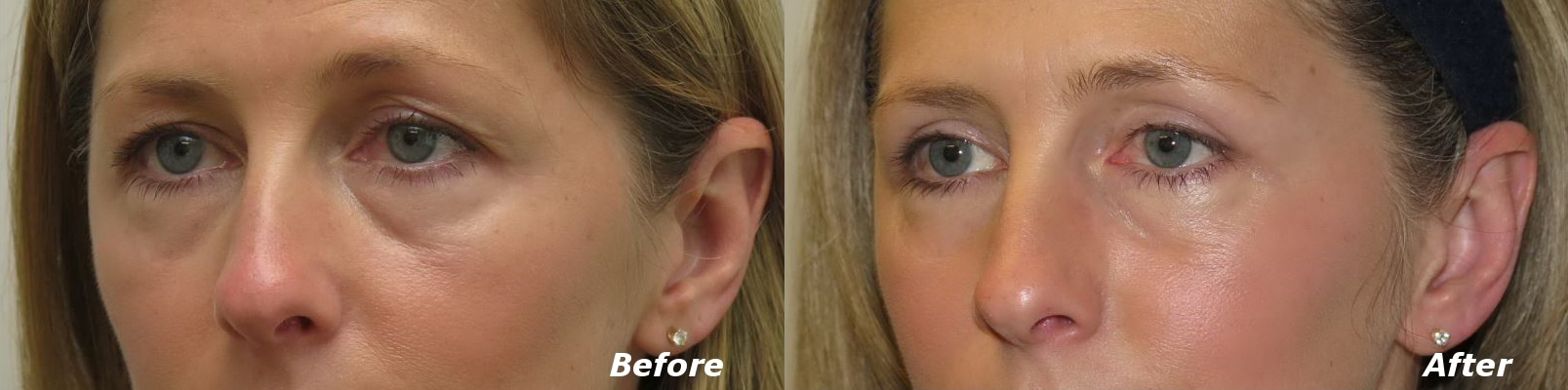 Eyelid Lift Before and After Photo by Ganchi Plastic Surgery in Northern New Jersey