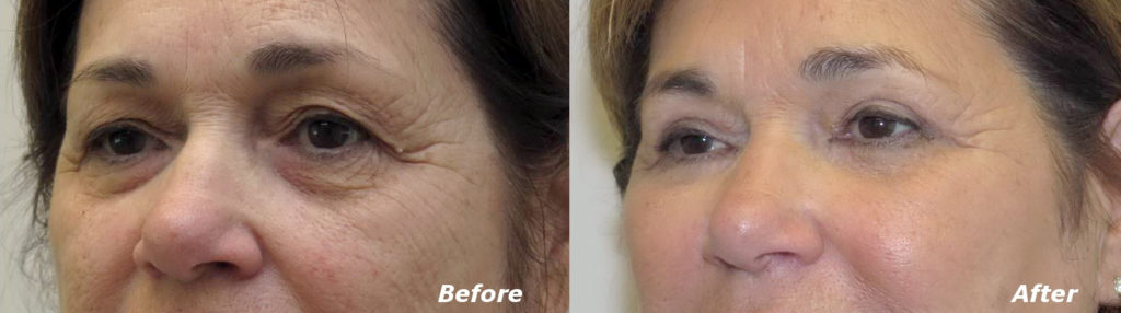 Eyelid Lift Before and After Photo by Ganchi Plastic Surgery in Northern New Jersey