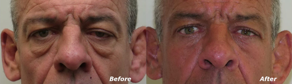 Eyelid Lift Before and After Photo by Ganchi Plastic Surgery in Northern New Jersey