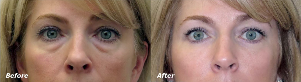 Eyelid Lift Before and After Photo by Ganchi Plastic Surgery in Northern New Jersey