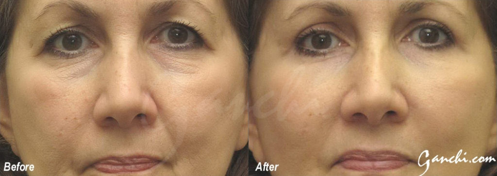 Eyelid Lift Before and After Photo by Ganchi Plastic Surgery in Northern New Jersey