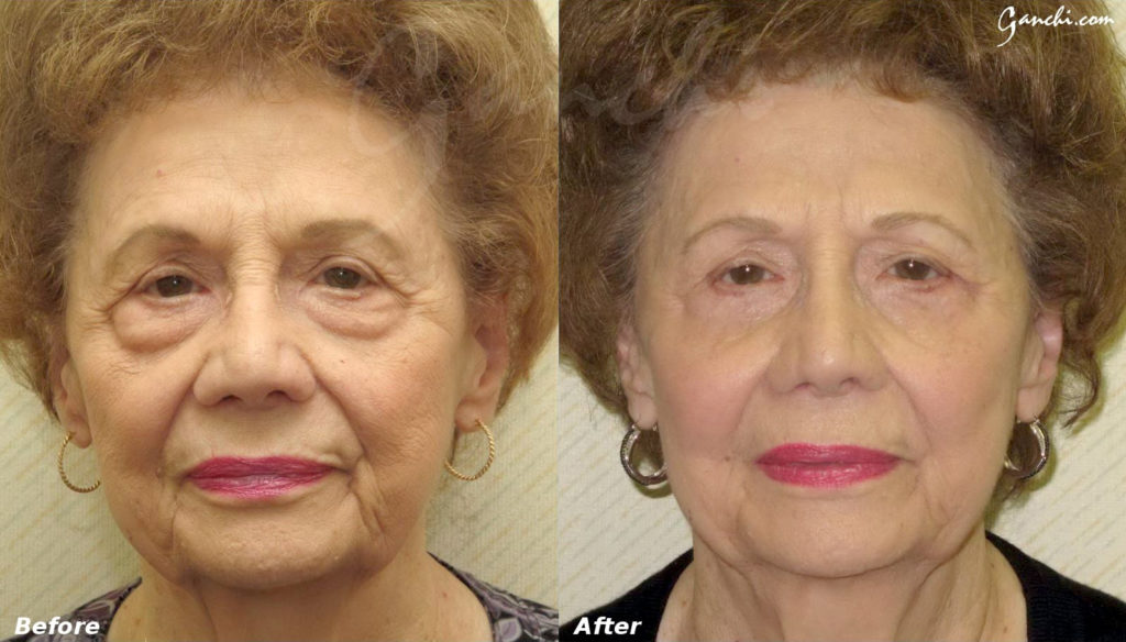 Eyelid Lift Before and After Photo by Ganchi Plastic Surgery in Northern New Jersey