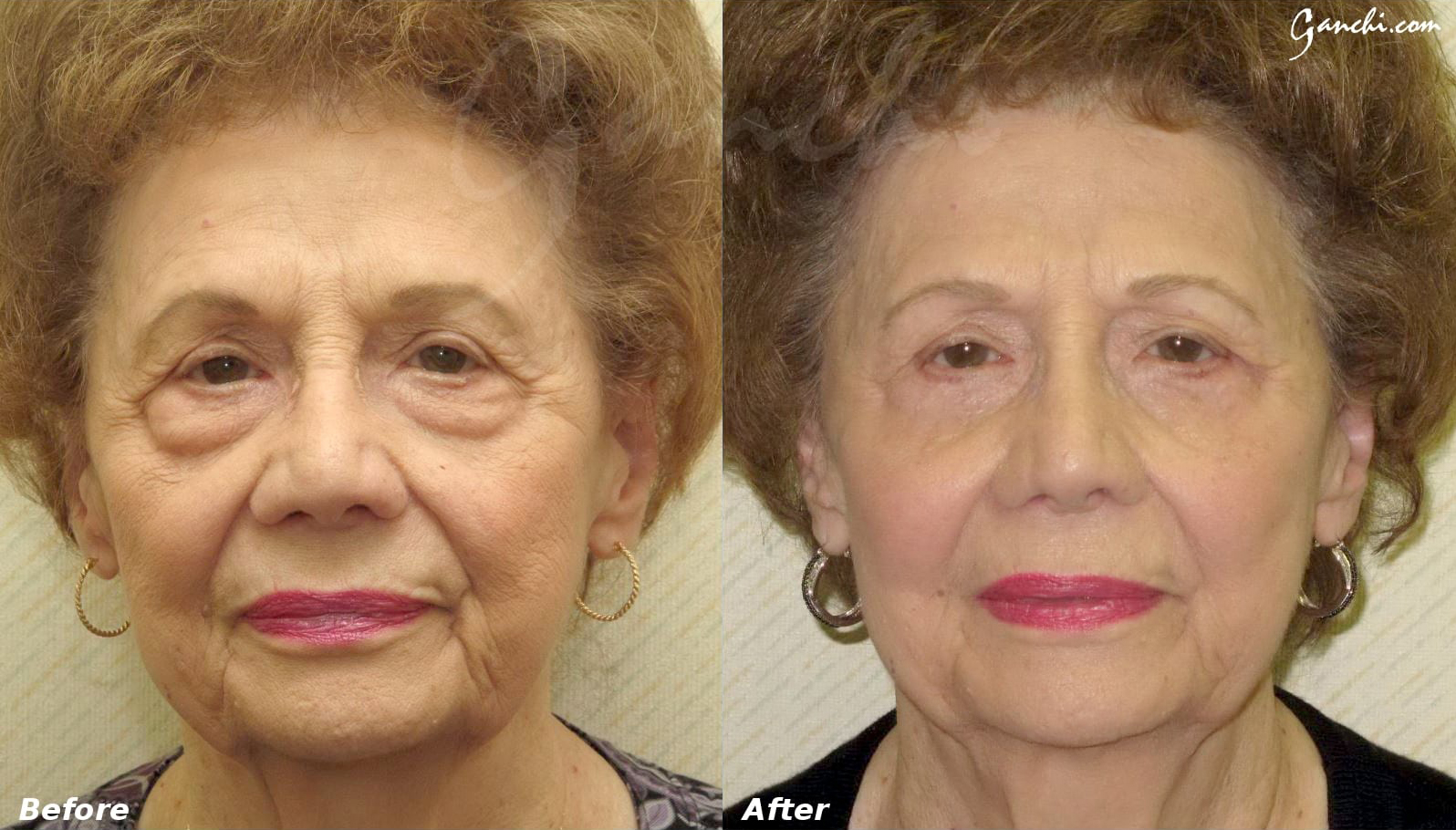 Eyelid Lift Before and After Photo by Ganchi Plastic Surgery in Northern New Jersey