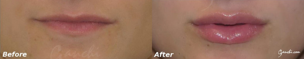 Lip Augmentation Before and After Photo by Ganchi Plastic Surgery in Northern New Jersey