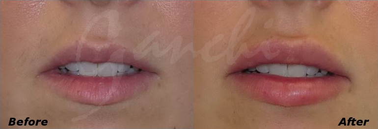 Lip Augmentation Before and After Photo by Ganchi Plastic Surgery in Northern New Jersey