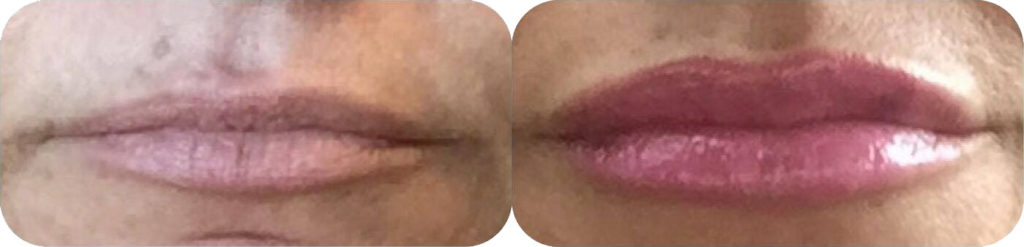 Lip Augmentation Before and After Photo by Ganchi Plastic Surgery in Northern New Jersey