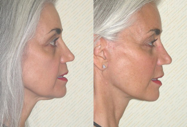 Facial Implants Before and After Photo by Ganchi Plastic Surgery in Northern New Jersey