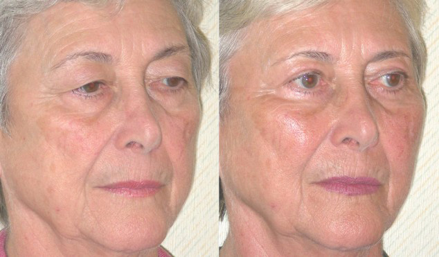 Facial Implants Before and After Photo by Ganchi Plastic Surgery in Northern New Jersey