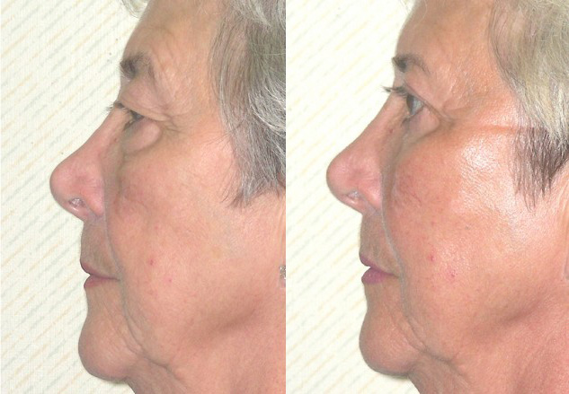 Facial Implants Before and After Photo by Ganchi Plastic Surgery in Northern New Jersey