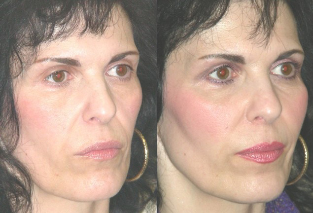 Facial Implants Before and After Photo by Ganchi Plastic Surgery in Northern New Jersey