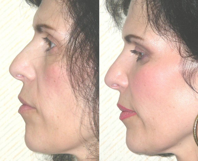 Facial Implants Before and After Photo by Ganchi Plastic Surgery in Northern New Jersey