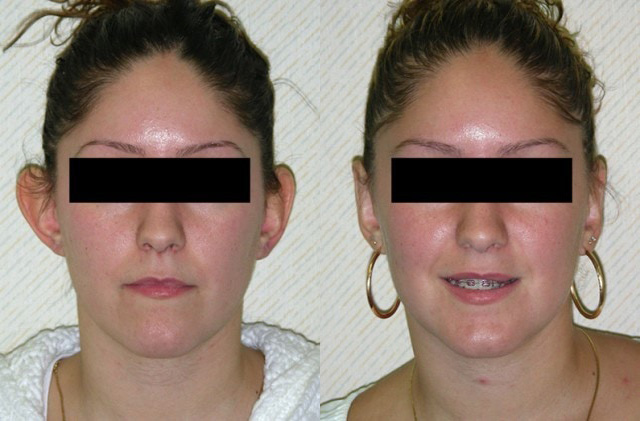 Otoplasty Before and After Photo by Ganchi Plastic Surgery in Northern New Jersey