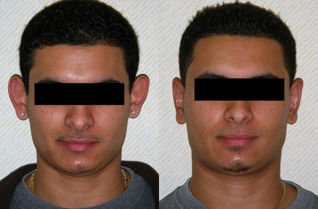 Otoplasty Before and After Photo by Ganchi Plastic Surgery in Northern New Jersey