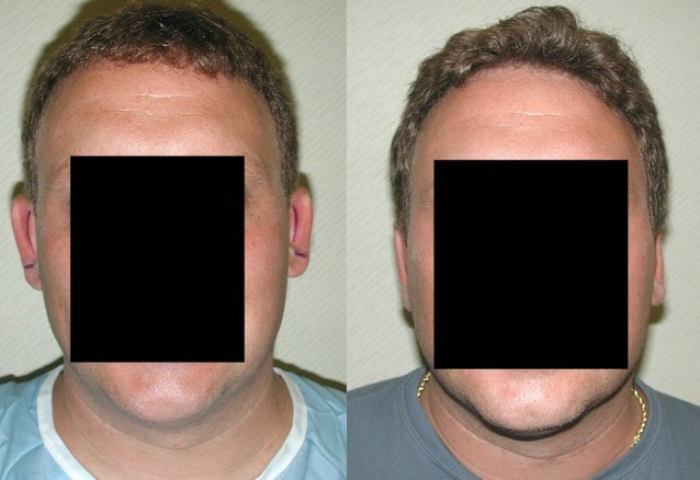 Otoplasty Before and After Photo by Ganchi Plastic Surgery in Northern New Jersey