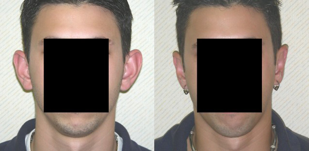 Otoplasty Before and After Photo by Ganchi Plastic Surgery in Northern New Jersey