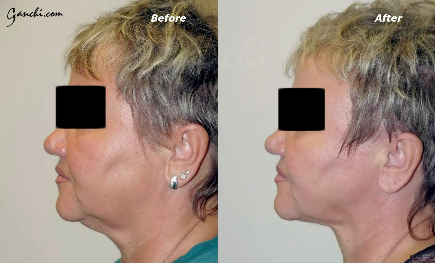 Face & Neck Liposuction Before and After Photo by Ganchi Plastic Surgery in Northern New Jersey