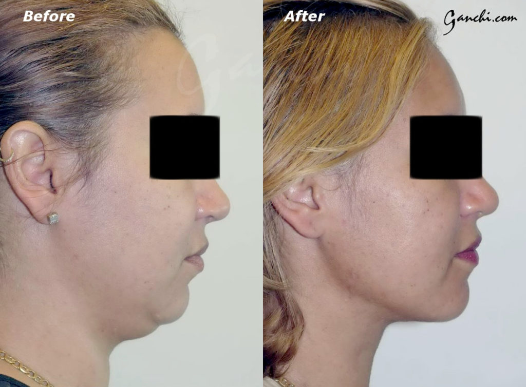 Face & Neck Liposuction Before and After Photo by Ganchi Plastic Surgery in Northern New Jersey
