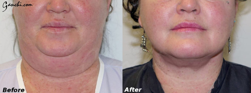 Face & Neck Liposuction Before and After Photo by Ganchi Plastic Surgery in Northern New Jersey