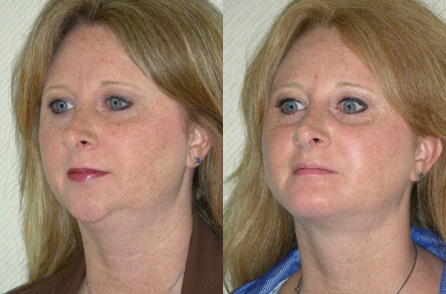 Face & Neck Liposuction Before and After Photo by Ganchi Plastic Surgery in Northern New Jersey