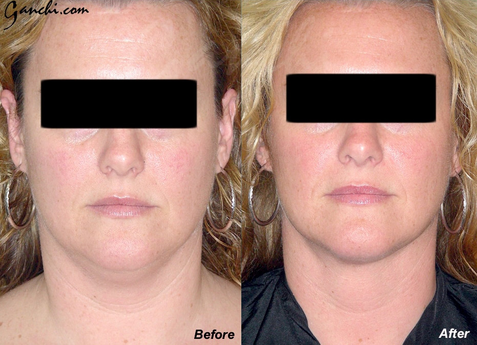 Face & Neck Liposuction Before and After Photo by Ganchi Plastic Surgery in Northern New Jersey