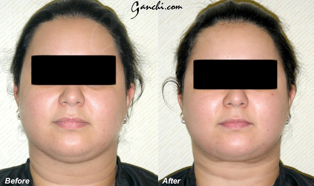 Face & Neck Liposuction Before and After Photo by Ganchi Plastic Surgery in Northern New Jersey