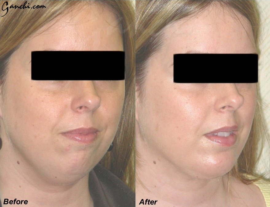 Face & Neck Liposuction Before and After Photo by Ganchi Plastic Surgery in Northern New Jersey