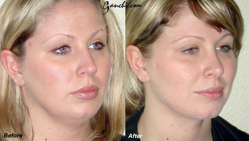 Face & Neck Liposuction Before and After Photo by Ganchi Plastic Surgery in Northern New Jersey
