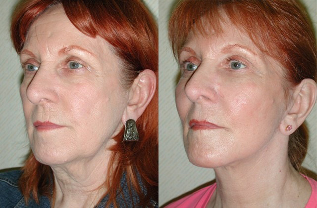 Necklift Before and After Photo by Ganchi Plastic Surgery in Northern New Jersey