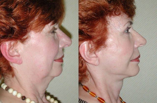 Necklift Before and After Photo by Ganchi Plastic Surgery in Northern New Jersey