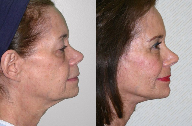 Necklift Before and After Photo by Ganchi Plastic Surgery in Northern New Jersey