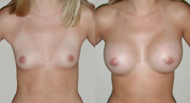 Breast Augmentation Before and After Photo by Ganchi Plastic Surgery in Northern New Jersey