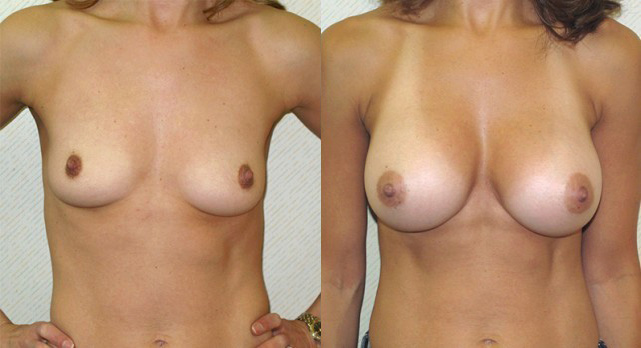 Breast Augmentation Before and After Photo by Ganchi Plastic Surgery in Northern New Jersey