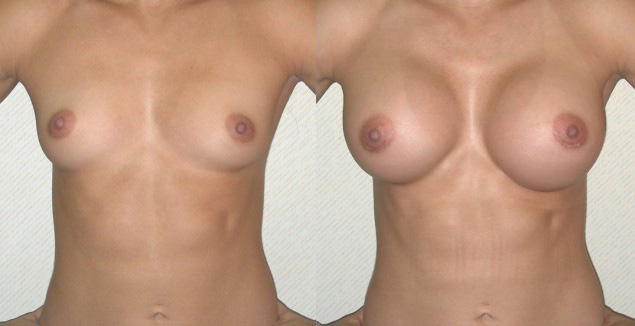 Breast Augmentation Before and After Photo by Ganchi Plastic Surgery in Northern New Jersey