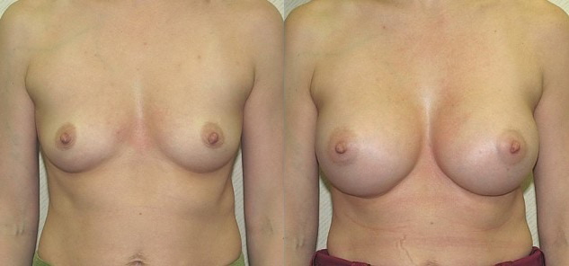 Breast Augmentation Before and After Photo by Ganchi Plastic Surgery in Northern New Jersey