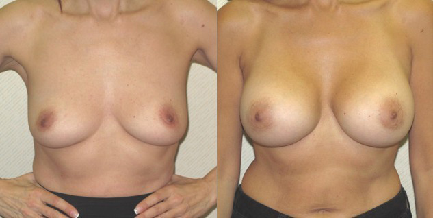 Breast Augmentation Before and After Photo by Ganchi Plastic Surgery in Northern New Jersey