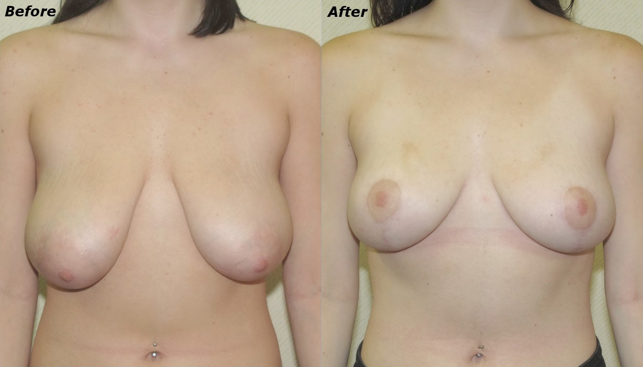 Breast Lift Before and After Photo by Ganchi Plastic Surgery in Northern New Jersey